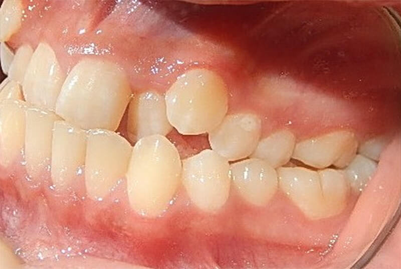 Fig. 5 Intraoral izquierda