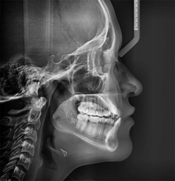 Fig. 6 Radiografía lateral de cráneo