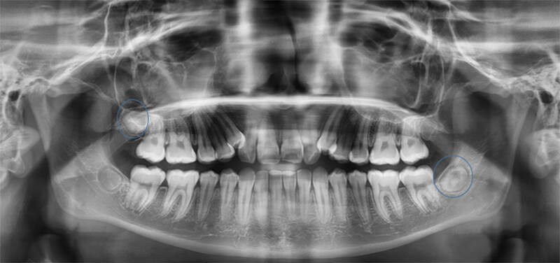 Fig. 7 Radiografía panorámica inicio