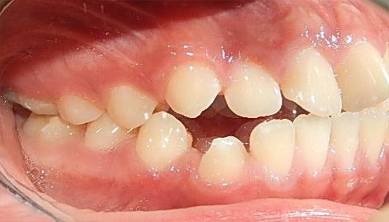 Fig. 3 lateral derecha