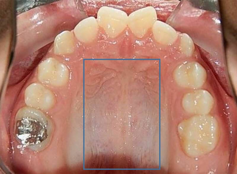 Fig.6 oclusal superior