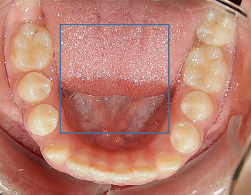 Fig.6 oclusal inferior