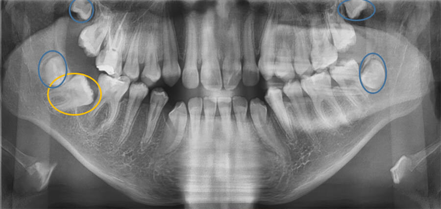 Fig. 7 radiografía panorámica