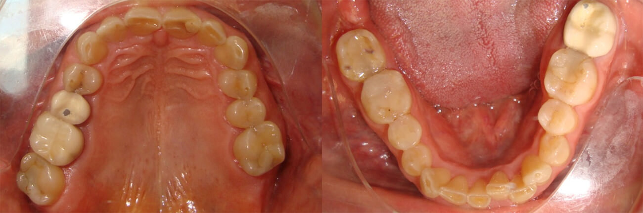 Figura 2. Fotografías intraorales, oclusal superior e inferior.