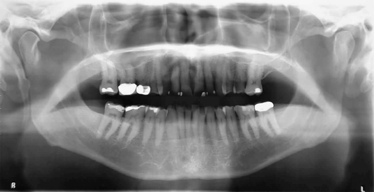 Figura 3. Radiografía panorámica, apófisis estiloides elongada del lado derecho.