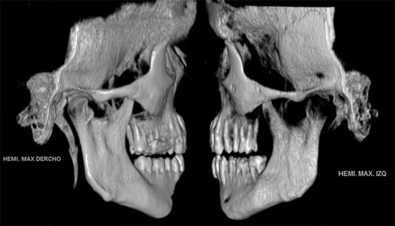 Figura 5. TAC multicorte 3D. Comparación entre apófisis estiloides derecha  e izquierda, observándose la derecha de mayor longitud.
