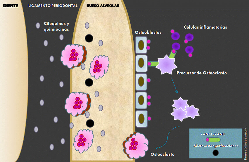 Figura 1. Efecto esquemático de las micro-osteoperforaciones