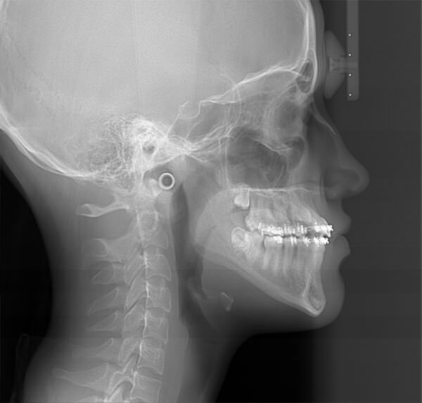 Después de tracción con Máscara Facial Ortopédica