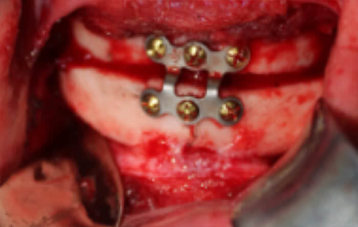 Fig. 11 Mentoplastía