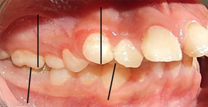 Fig. 13 Lateral derecha de inicio y final