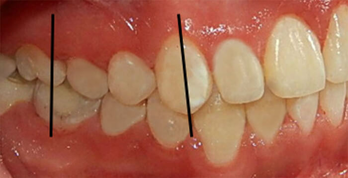 Fig. 13 Lateral derecha de inicio y final