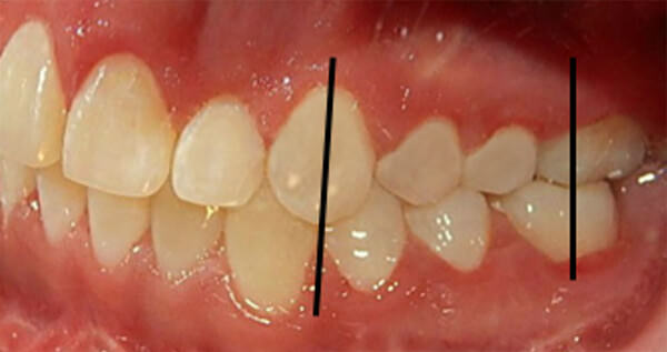 Fig. 14  comparación  izquierda inicio y final