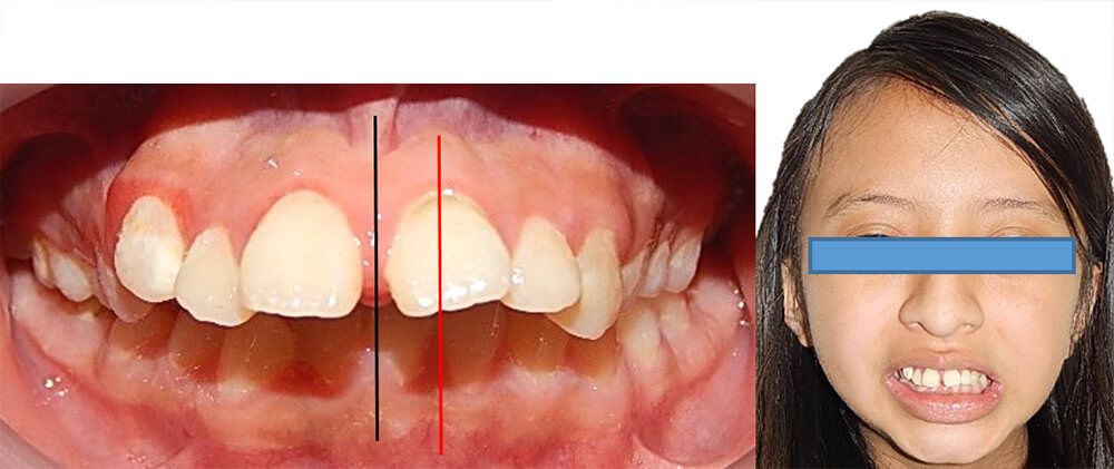 Fig. 15 intraoral y extraoral de frente inicio