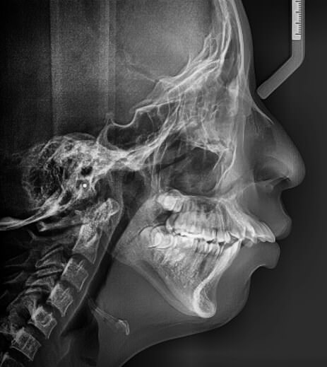 Fig. 2 Radiografía lateral de cráneo