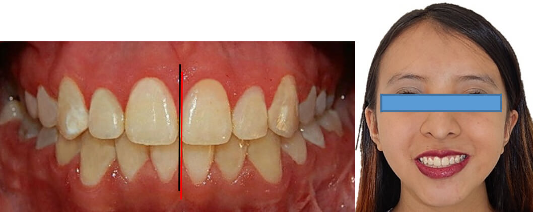 Fig. 16 F intraoral y extraoral de frente final