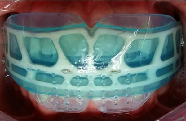 Fig. 17 Vista  de los retenedores y el  Trainer i2