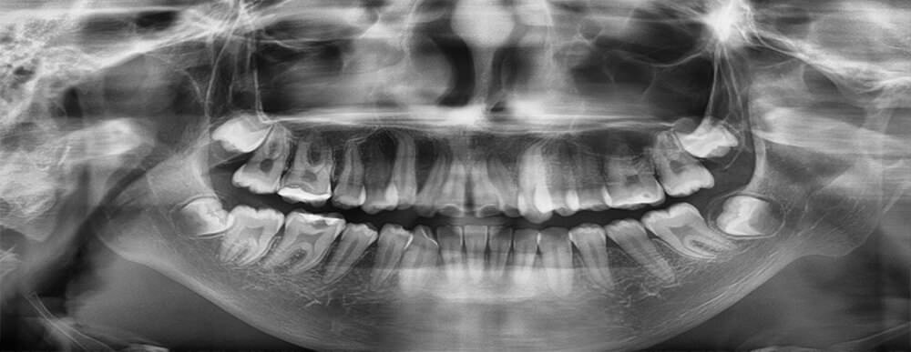 Fig. 3 Radiografía panorámica