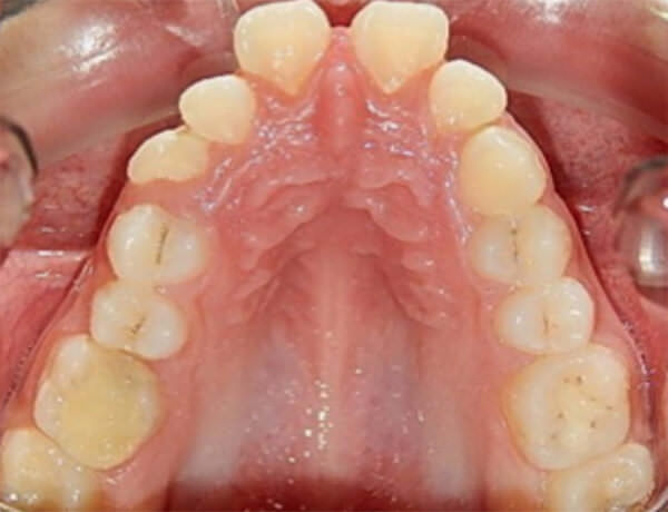 Fig.5 Oclusal superior e inferior