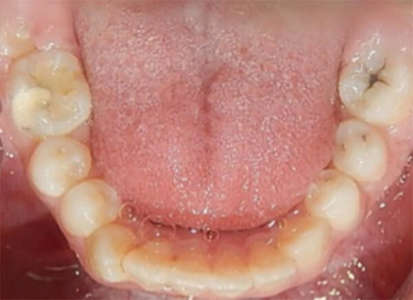 Fig.5 Oclusal superior e inferior