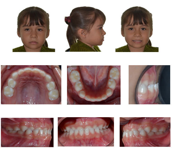Imagen 1. Fotografias faciales e intraorales iniciales