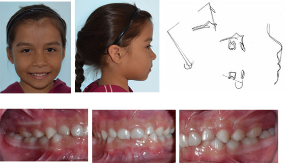 Imagen 3. Fotografías faciales e intraorales finales. Superposición radiográfica.