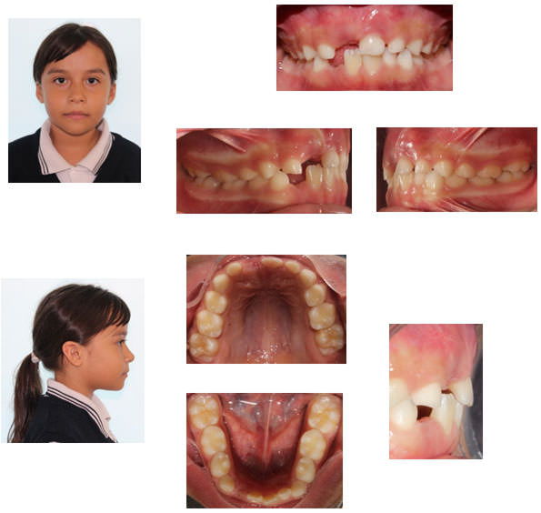 Imagen 4. Fotografías faciales e intraorales en retención