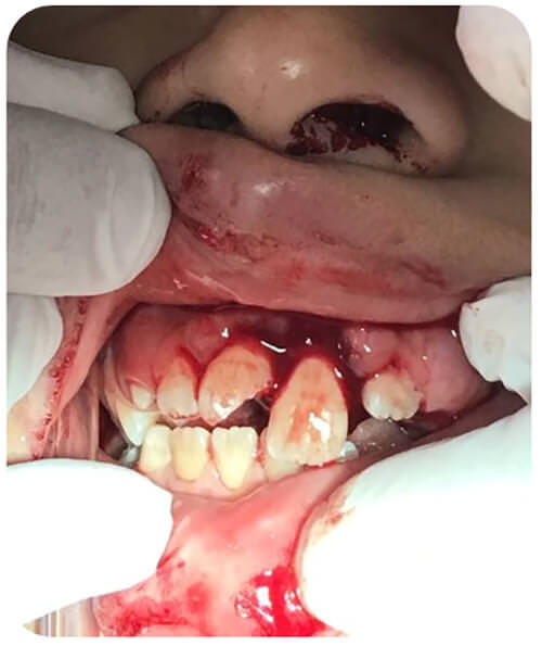Fotografía 1. Apariencia de las estructuras dentarias y mucosa bucal durante la primera inspección clínica.