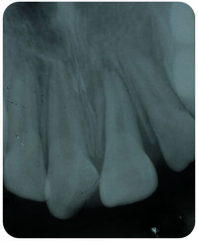 Fotografía 2. Radiografía periapical de los dientes traumatizados. El espacio un amplio espacio del LP en el OD 21, acompañado de una ligera rotación en su eje longitudinal.