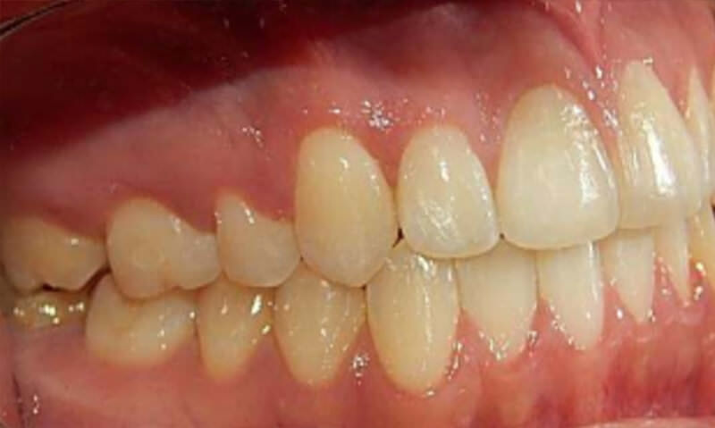 Fig. 12 Intraoral derecha