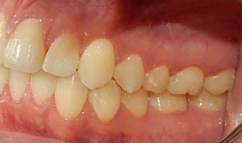 Fig. 14 lateral izquierda