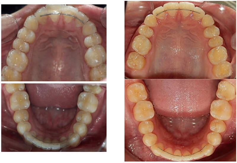 Fig. 15 Vista retenedores termoformados superior e inferior y los fijos en el superior de 2 a 2 e inferior de 3 a 3.