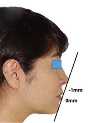 Fig. 2 Extraoral de perfil