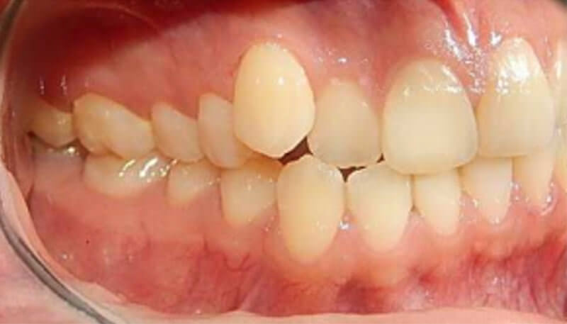 Fig. 4 Intraoral derecha