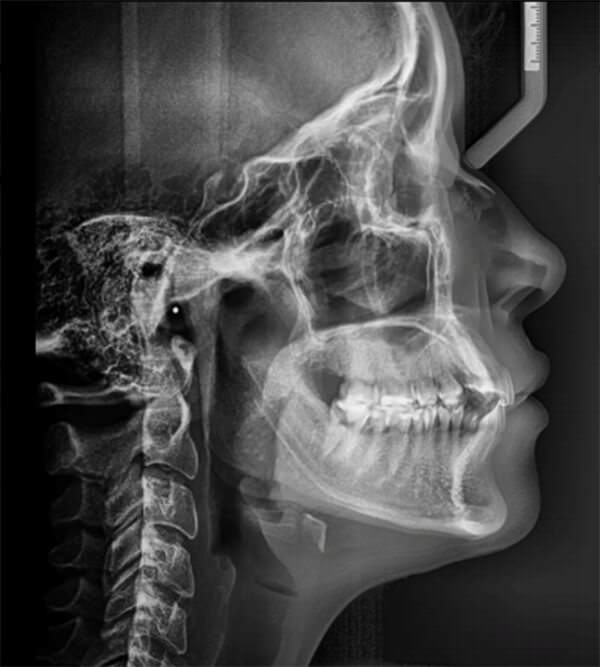 Fig. 6 Radiografía lateral de cráneo