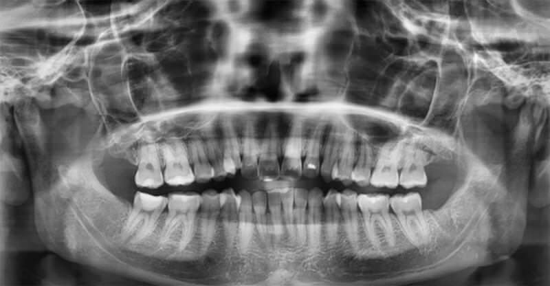 Fig. 7 Radiografía panorámica inicio