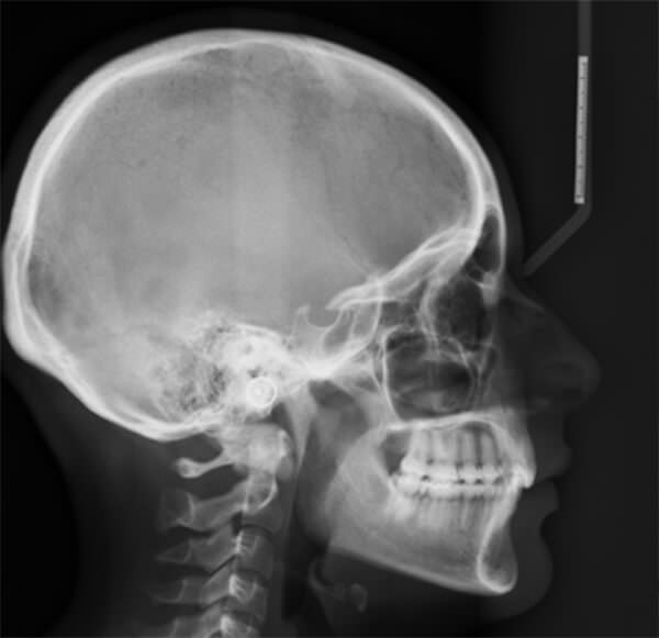 Fig. 1 Radiografía lateral de cráneo