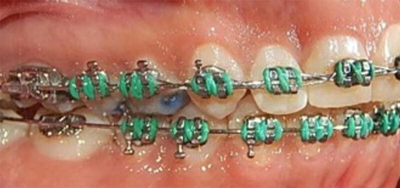 Fig.10 intraoral lateral derecha, izquierda  y la  de frente