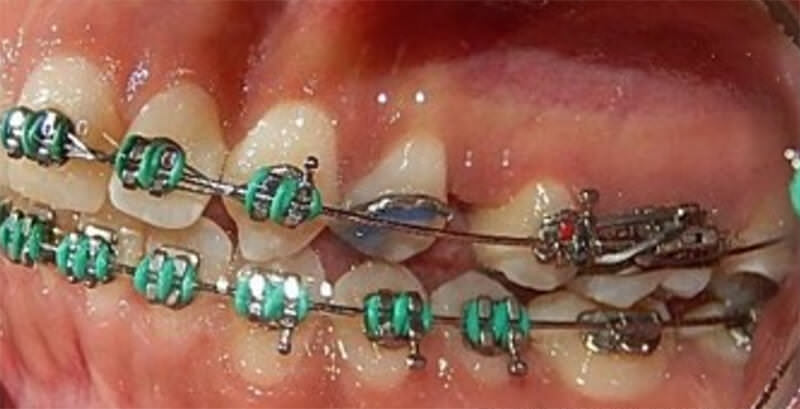 Fig.10 intraoral lateral derecha, izquierda  y la  de frente