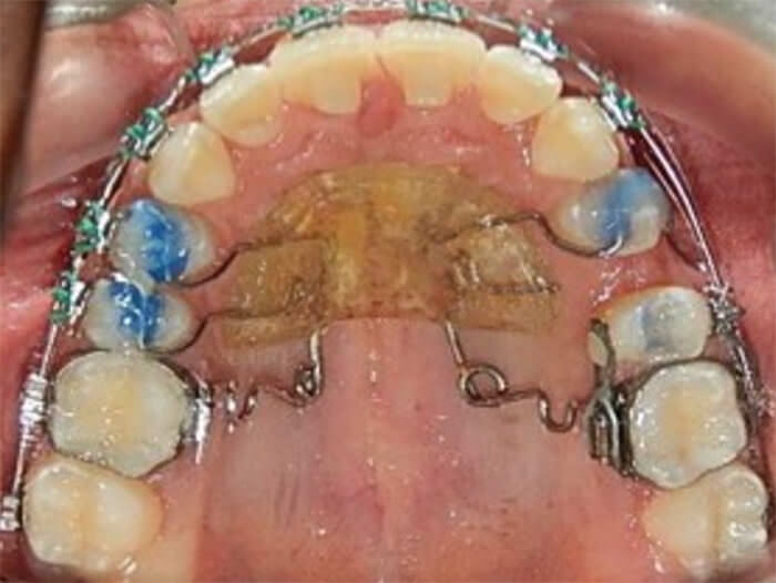 Fig. 11  vista oclusal  de las arcadas superior e inferior