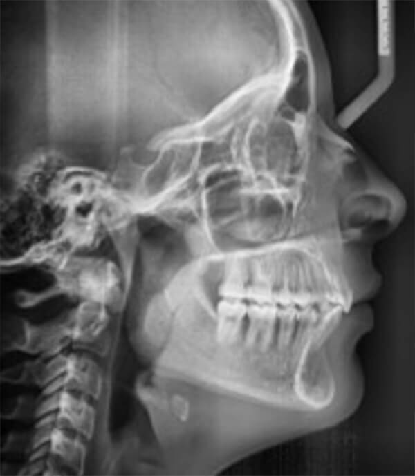 Fig. 12 Rx lateral de cráneo