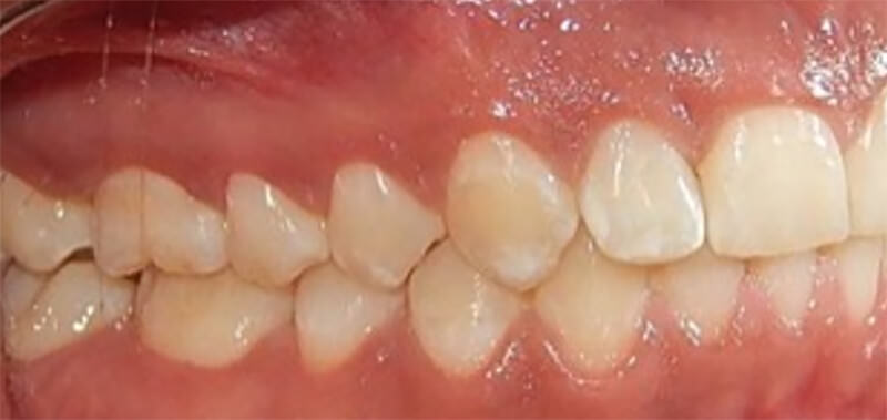 Fig. 14 intraoral derecha e izquierda