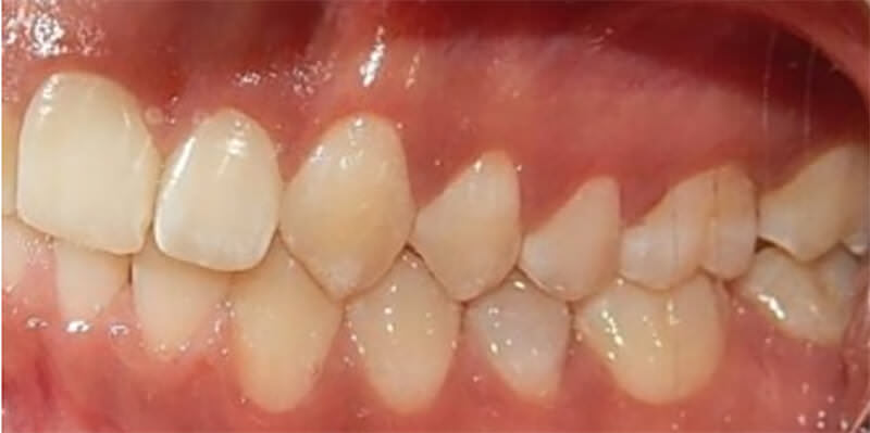 Fig. 14 intraoral derecha e izquierda