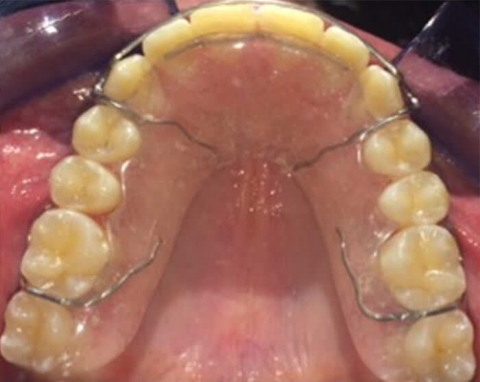 Fig. 19 retenedores superior e inferior y frente