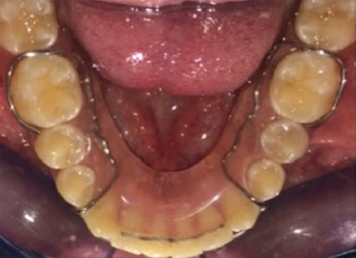 Fig. 19 retenedores superior e inferior y frente