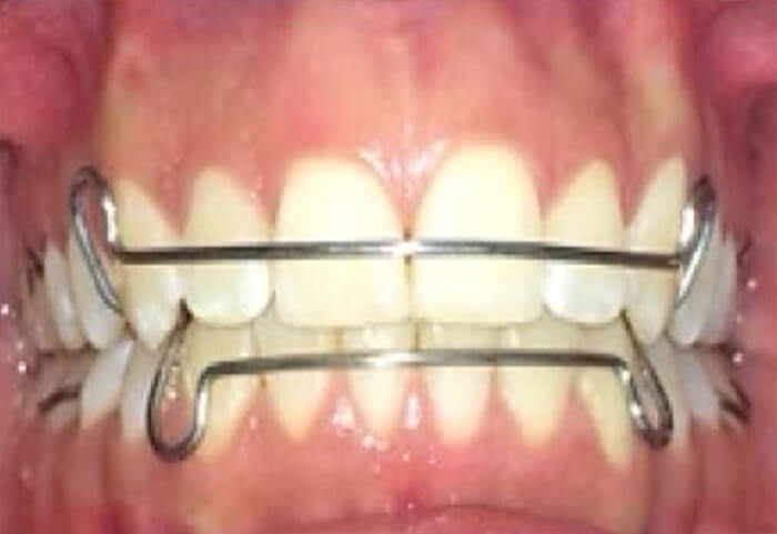 Fig. 19 retenedores superior e inferior y frente