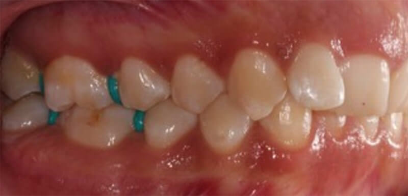 Fig. 3 Intraoral derecha