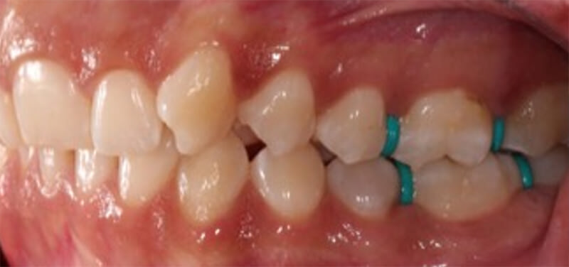 Fig. 4 Intraoral izquierda