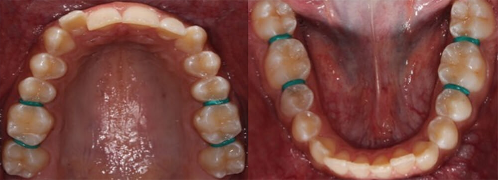 Fig. 6 oclusal superior e inferior