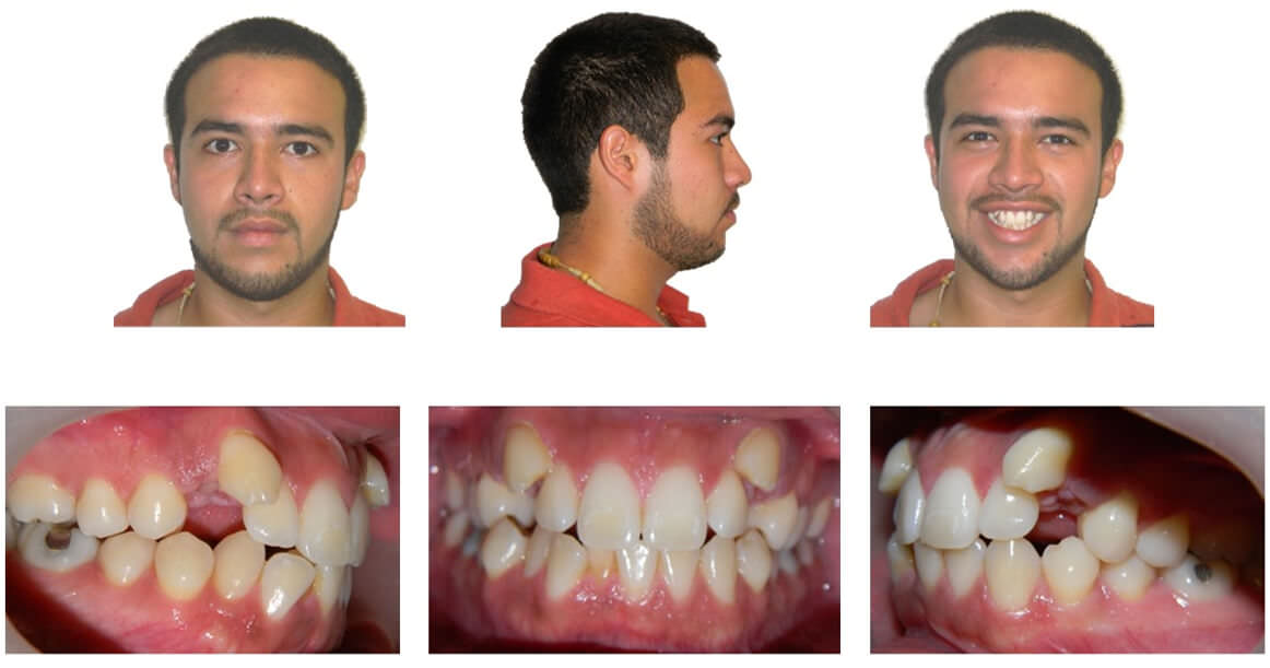 Imagen 1. Fotografías faciales e intraorales iniciales