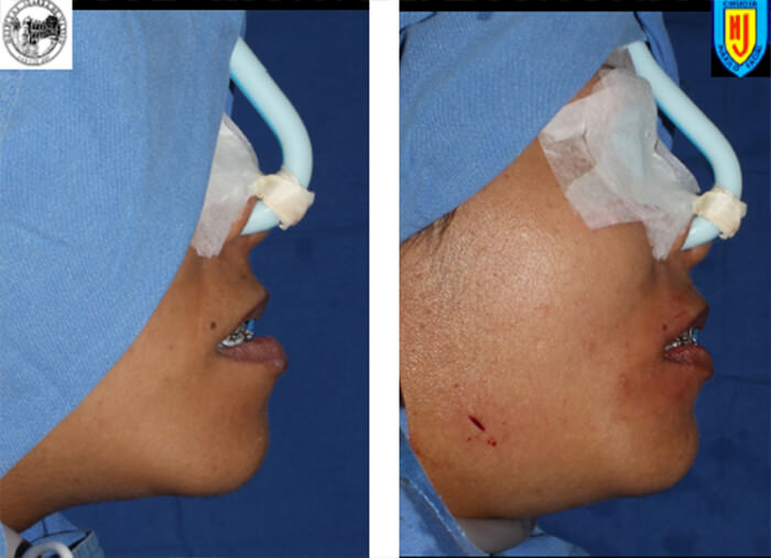 Fig. 11. Osteotomía sagital de rama bilateral y cambios faciales.